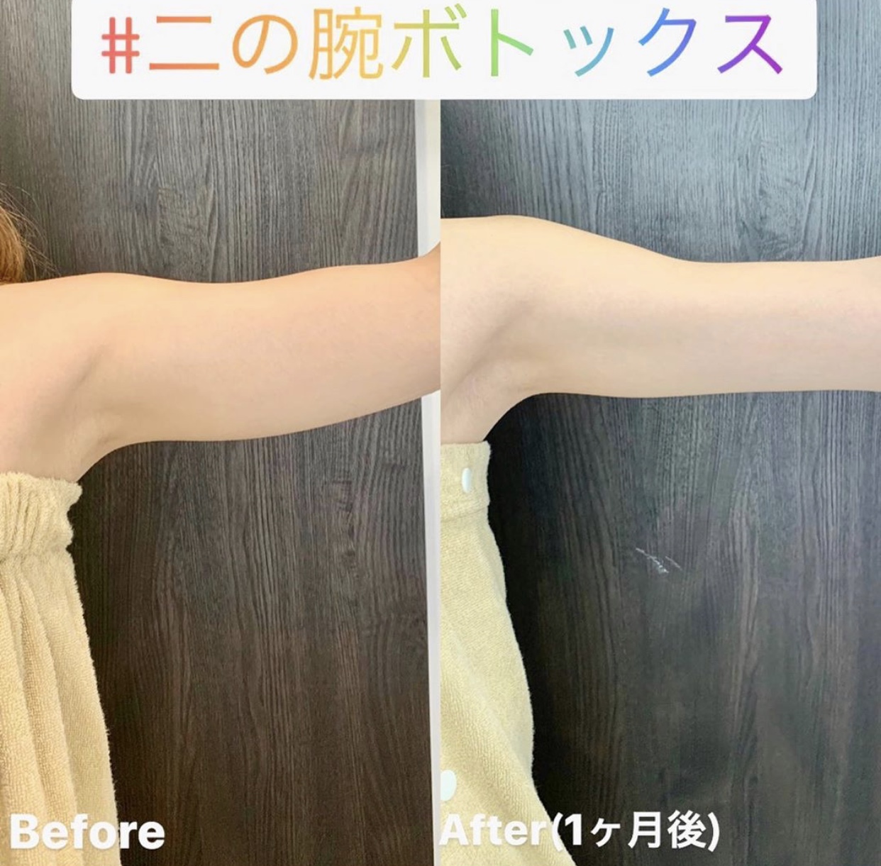 二の腕ボトックス