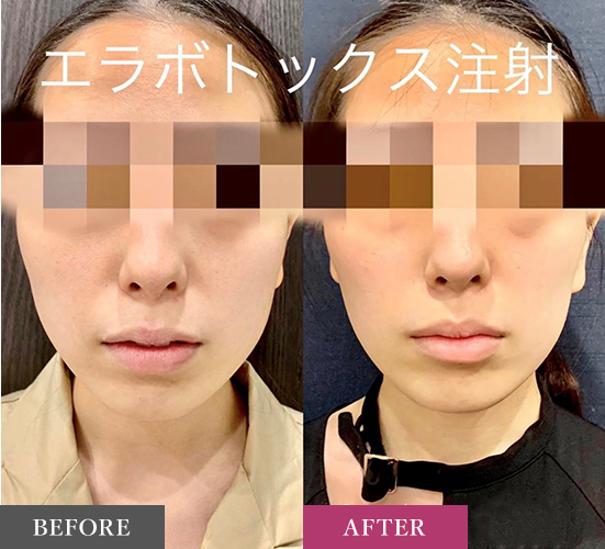 ボトックス注射の症例写真