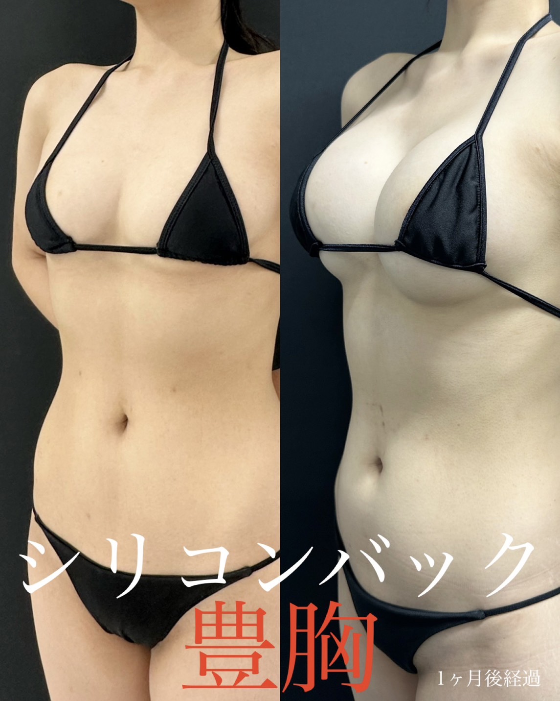 シリコンバッグ豊胸の症例写真