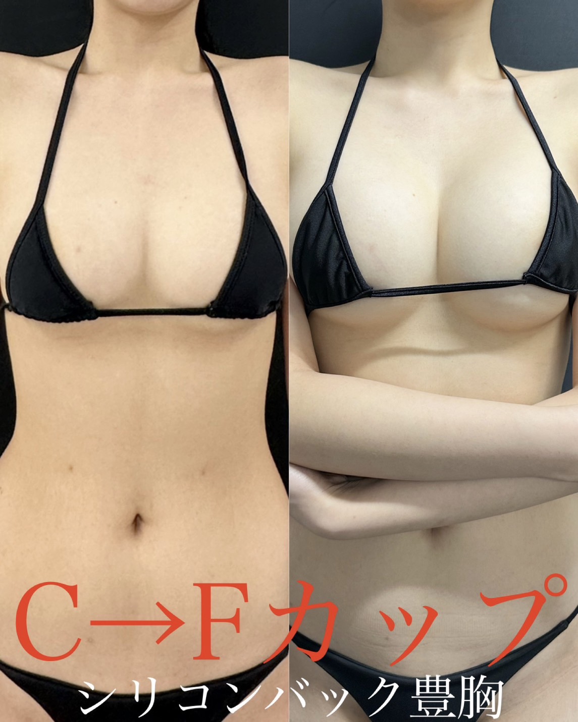 シリコンバッグ豊胸の症例写真