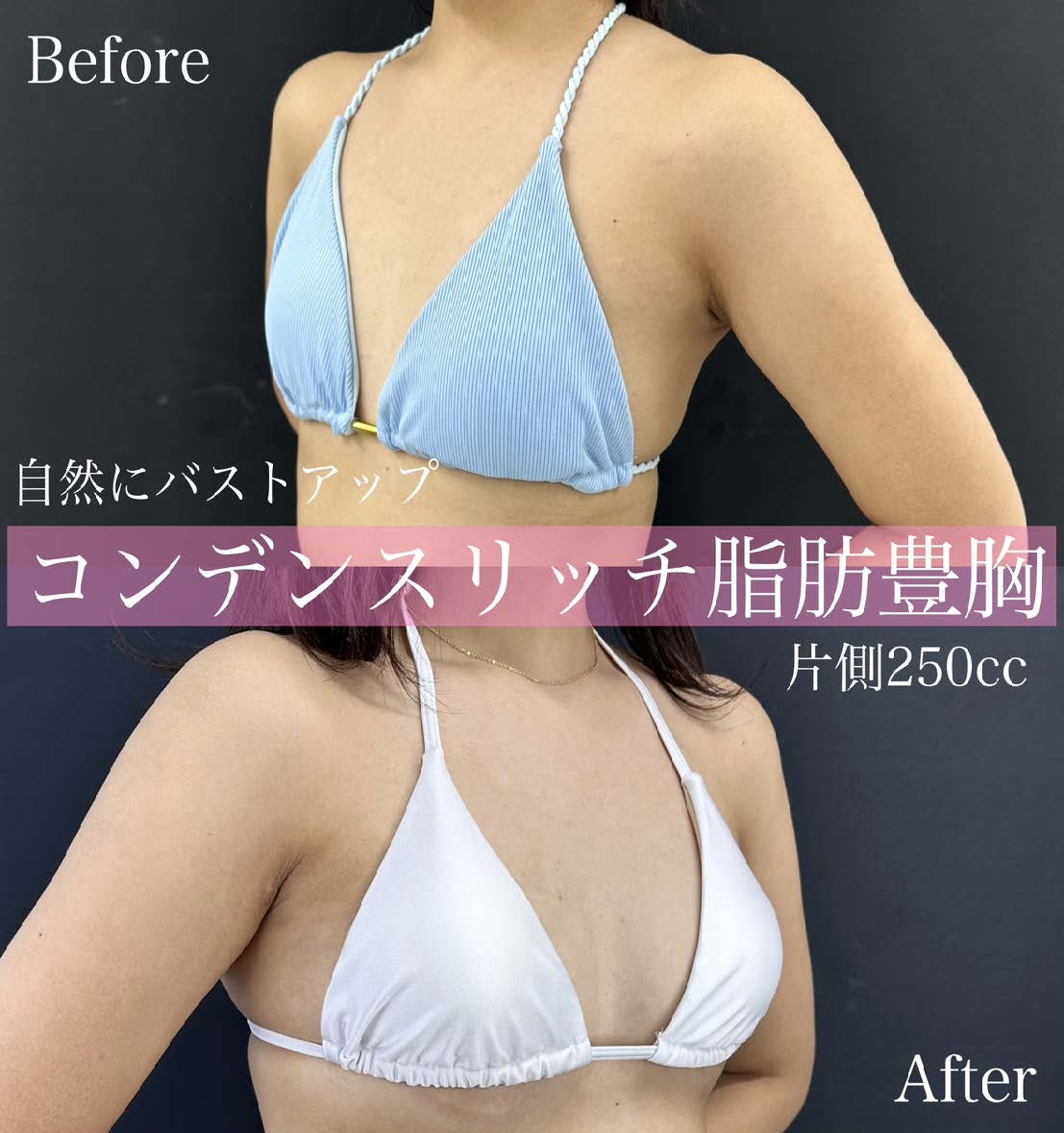 脂肪注入豊胸の症例写真