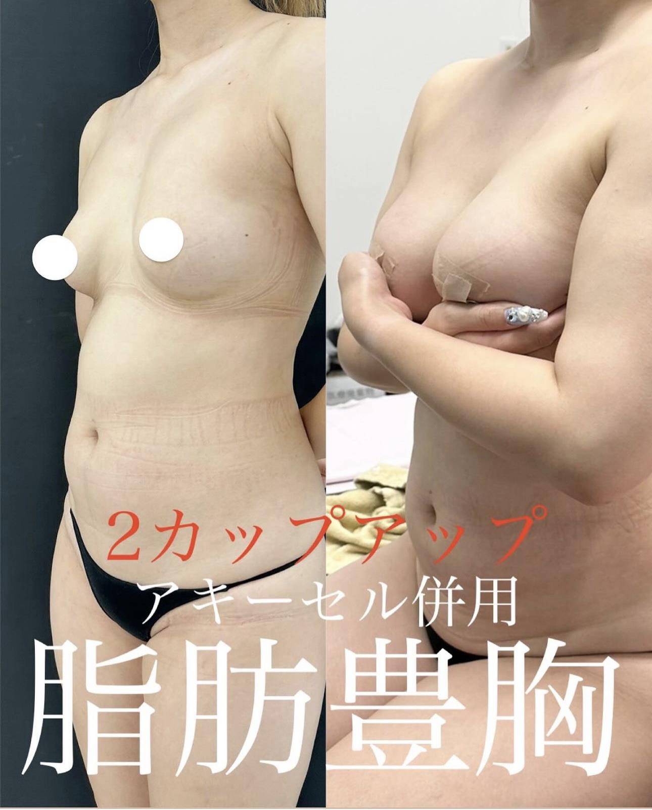 脂肪注入豊胸の症例写真