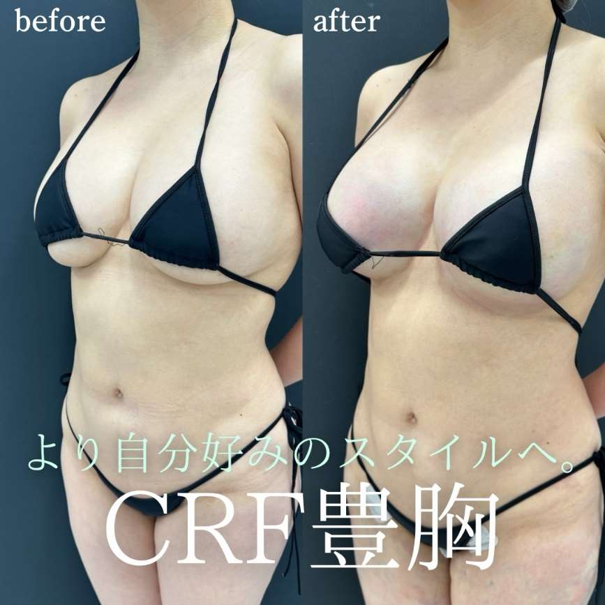 脂肪注入豊胸の症例写真