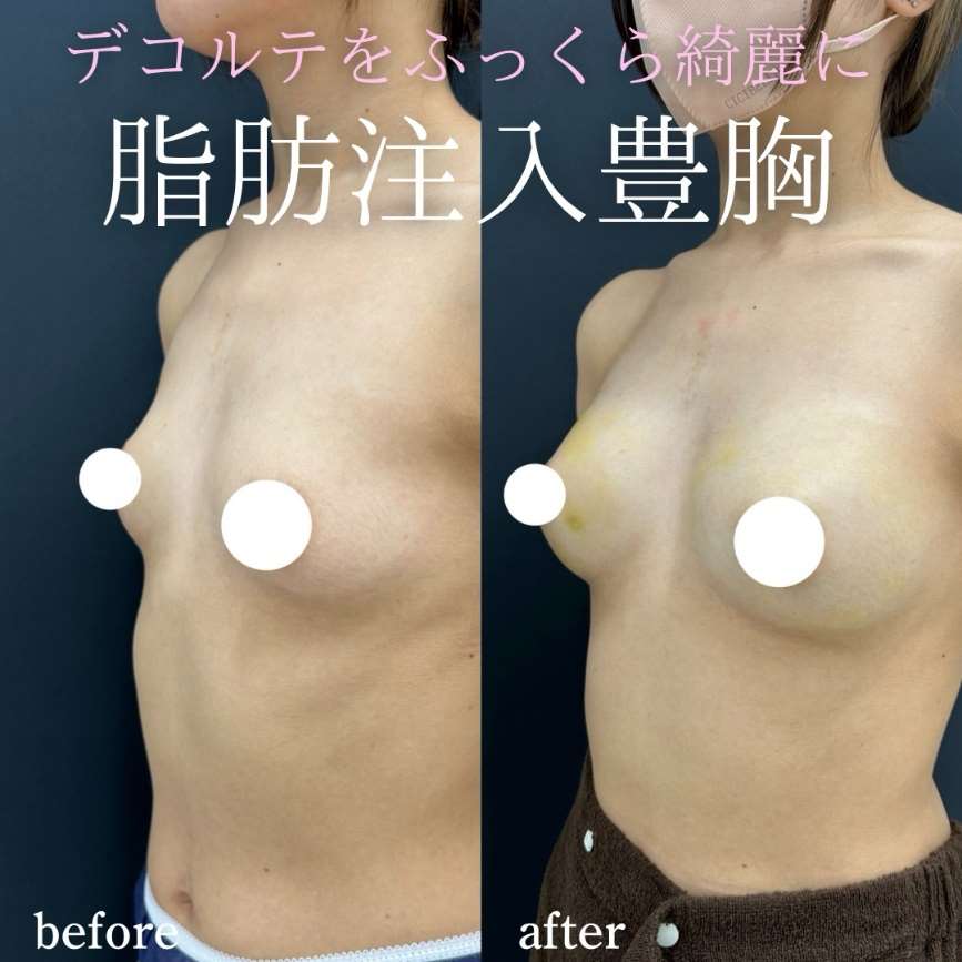 脂肪注入豊胸の症例写真