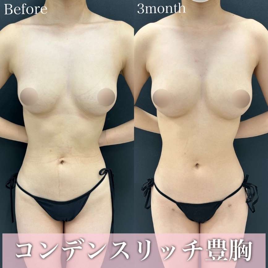 脂肪注入豊胸の症例写真