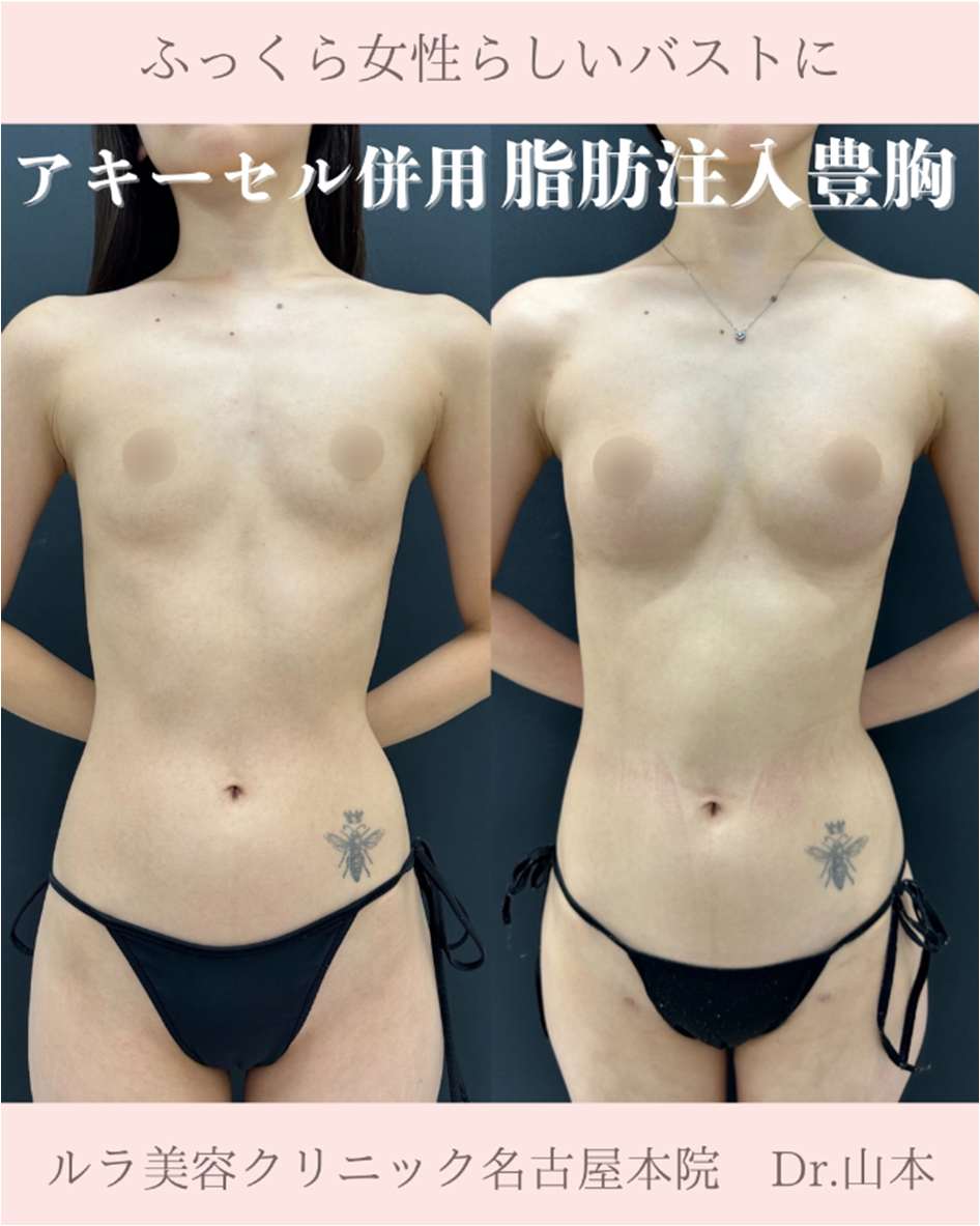 脂肪注入豊胸の症例写真