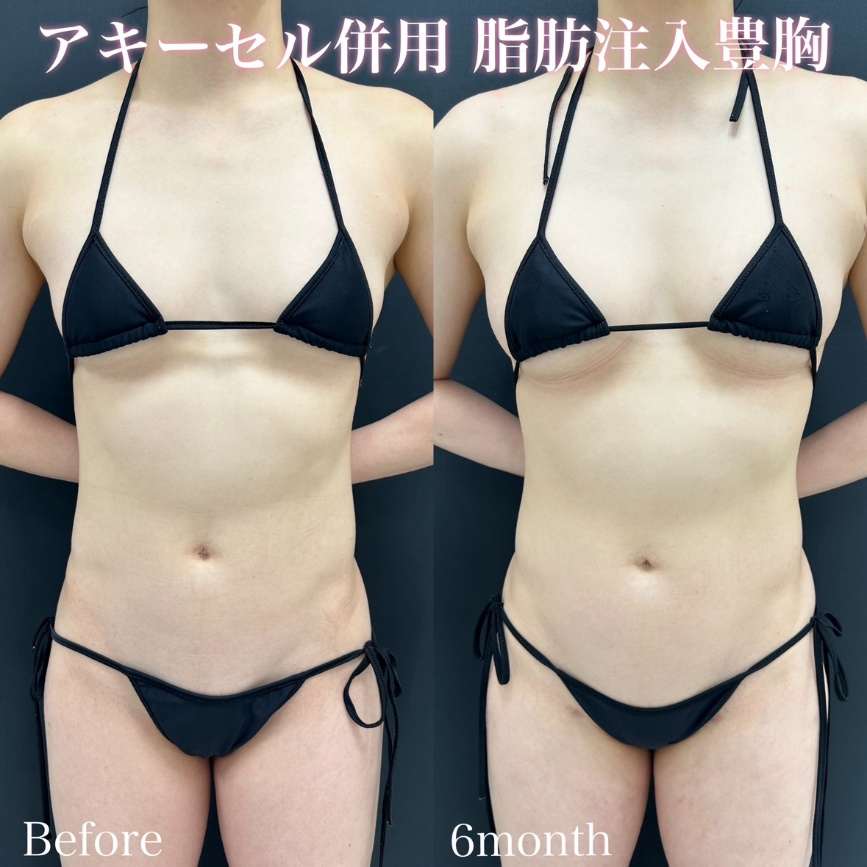 脂肪注入豊胸の症例写真