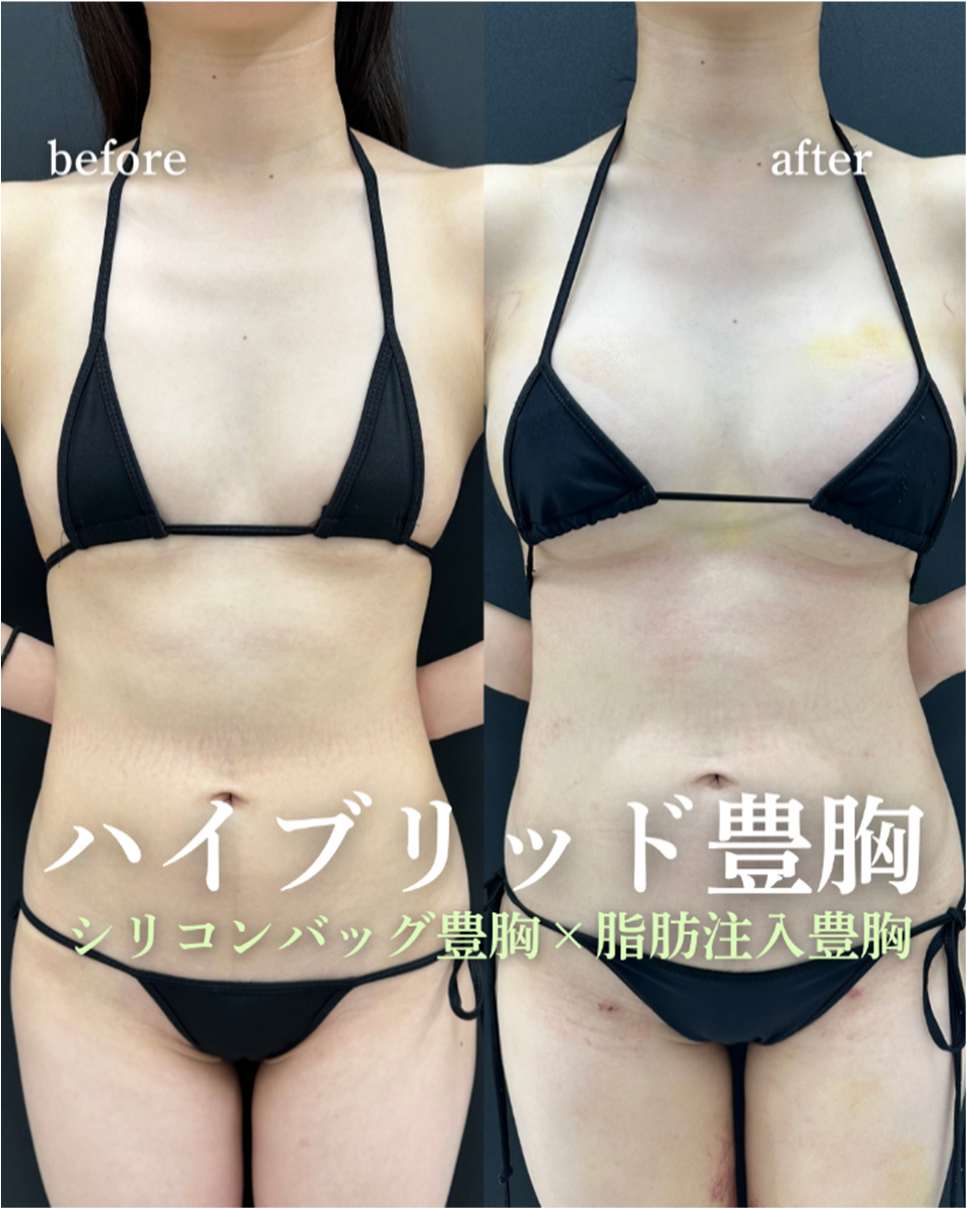 脂肪注入豊胸の症例写真