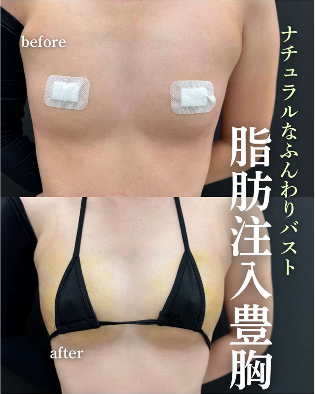 脂肪注入豊胸の症例写真