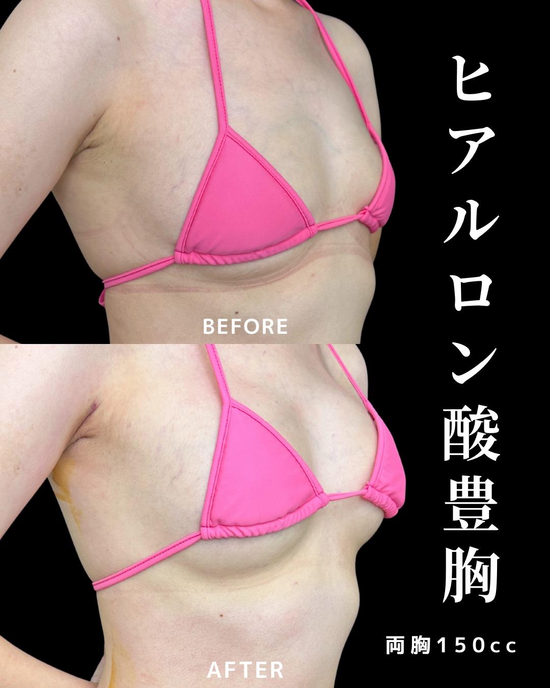 ヒアルロン酸豊胸の症例写真