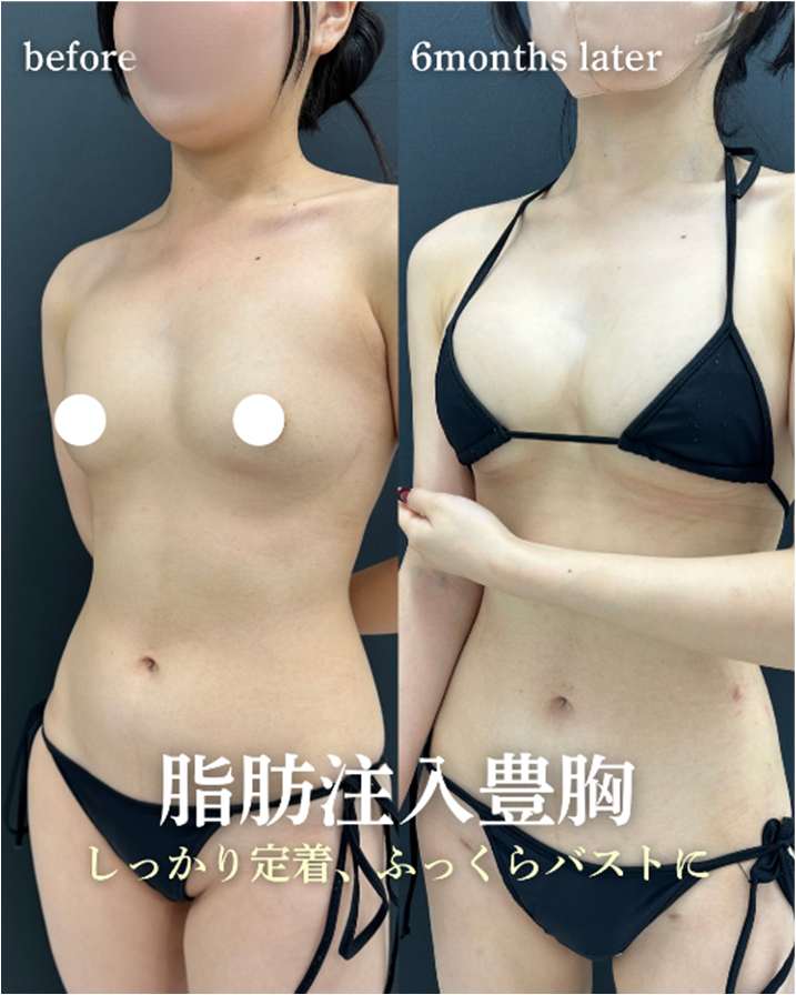 脂肪注入豊胸の症例写真