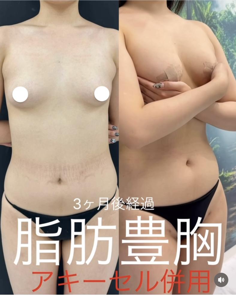 脂肪注入豊胸の症例写真