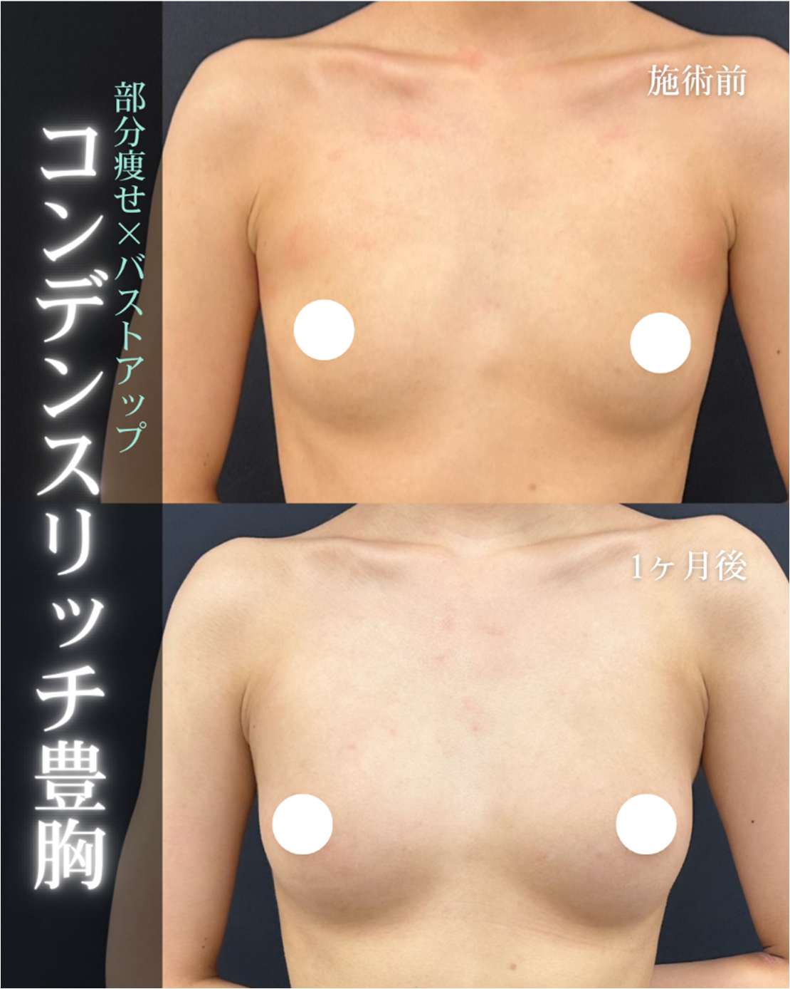 脂肪注入豊胸の症例写真