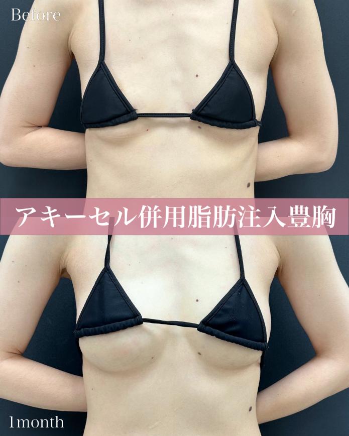 脂肪注入豊胸の症例写真