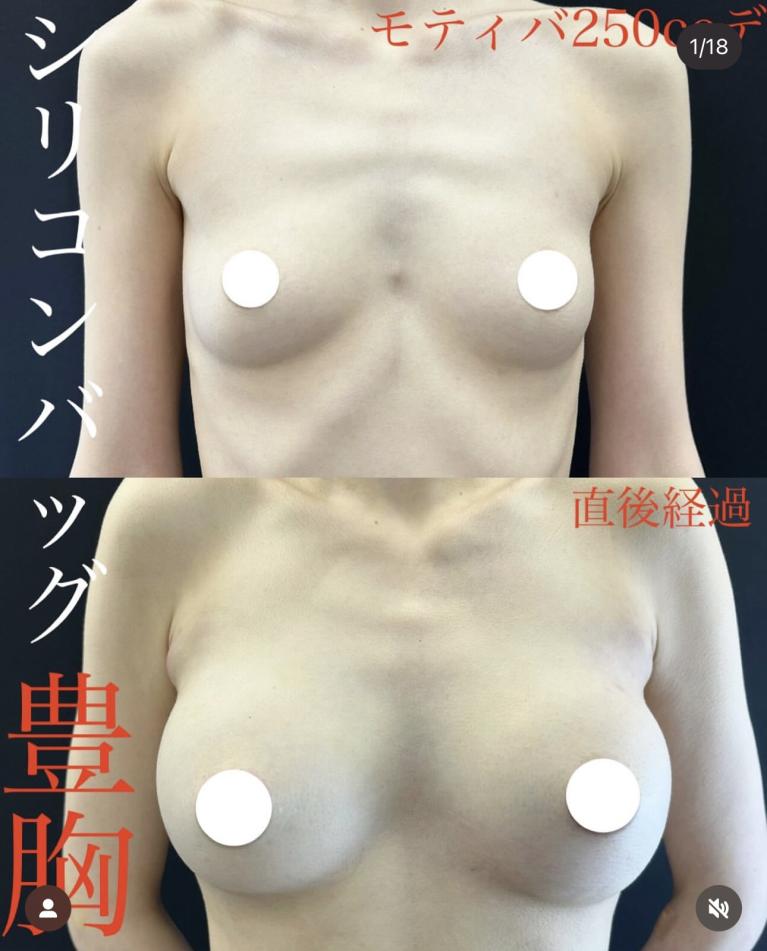 脂肪注入豊胸の症例写真