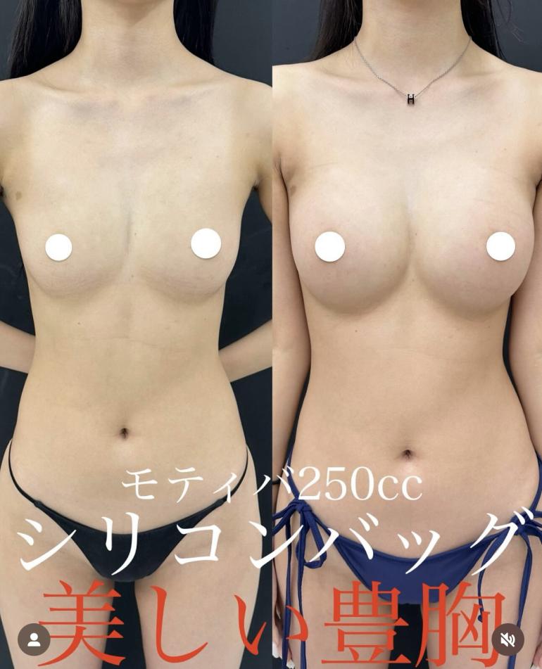 脂肪注入豊胸の症例写真