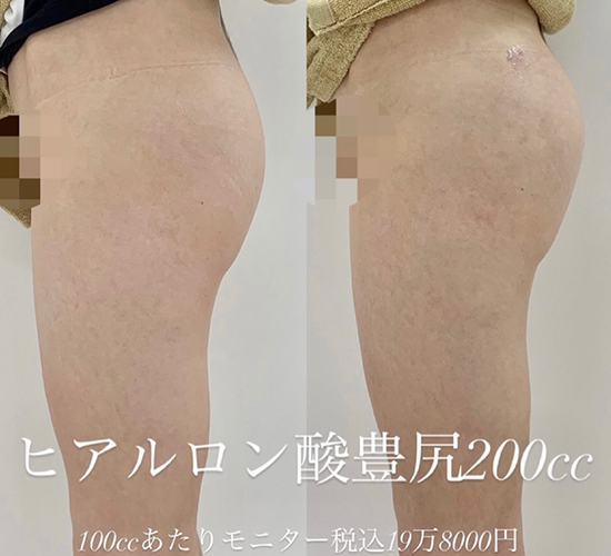 ヒアルロン酸豊尻の症例写真