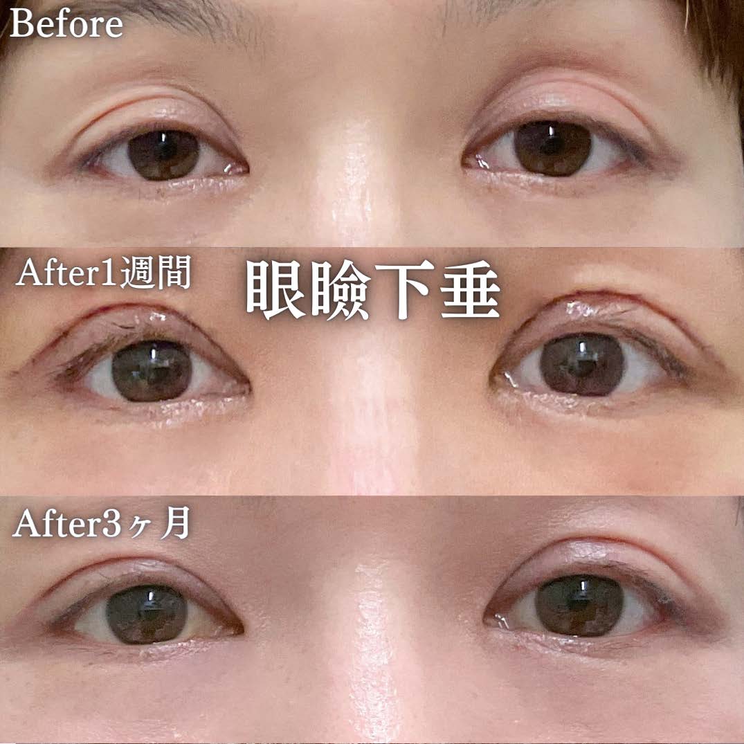 眼瞼下垂切開