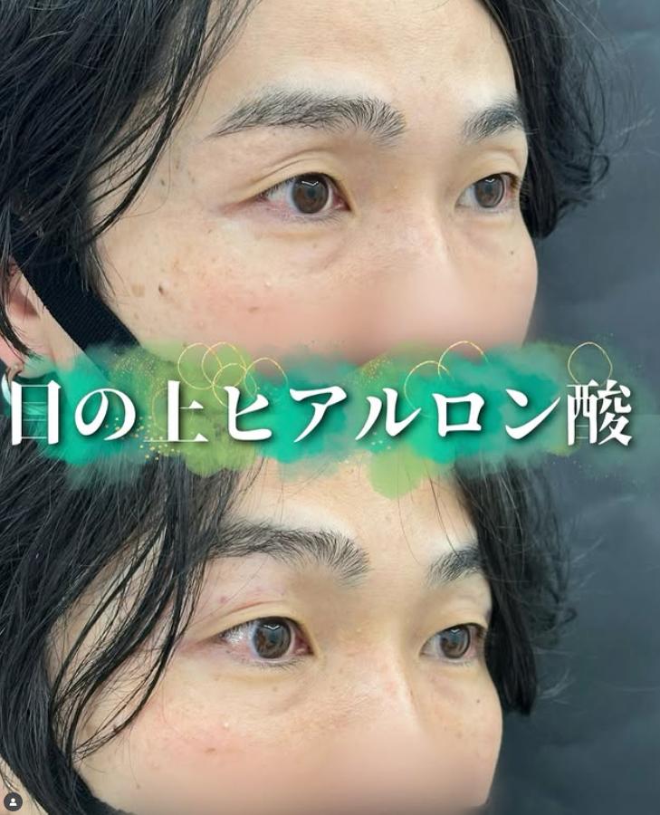目の上のヒアルロン酸の症例写真