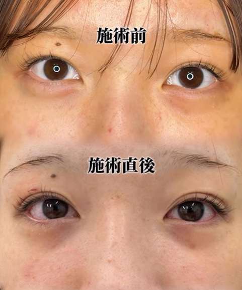 まぶたの上の脂肪取り