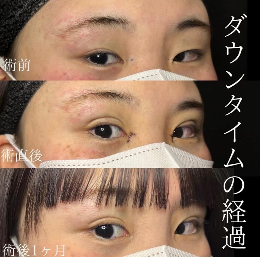 目頭切開法の症例写真