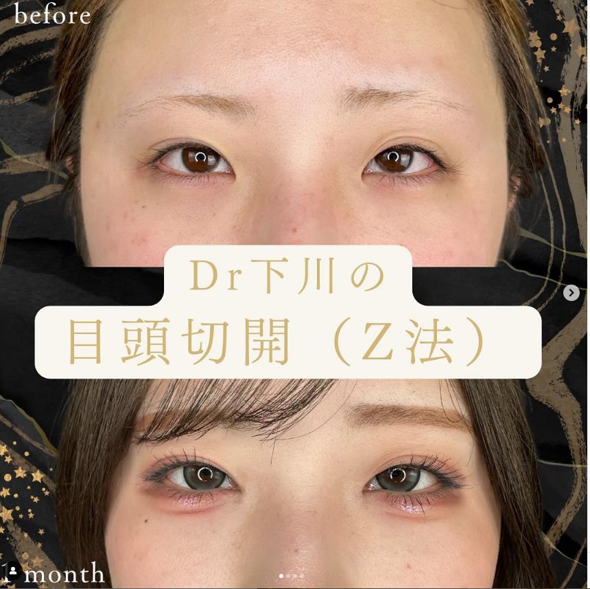 目頭切開法の症例写真