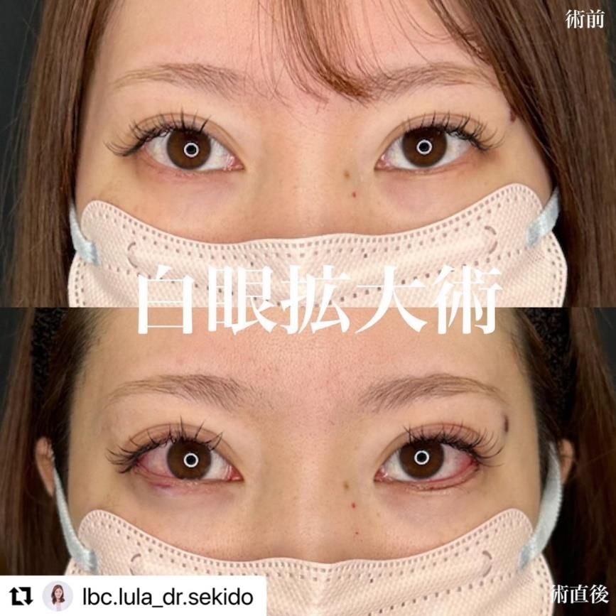 目尻切開法の症例写真