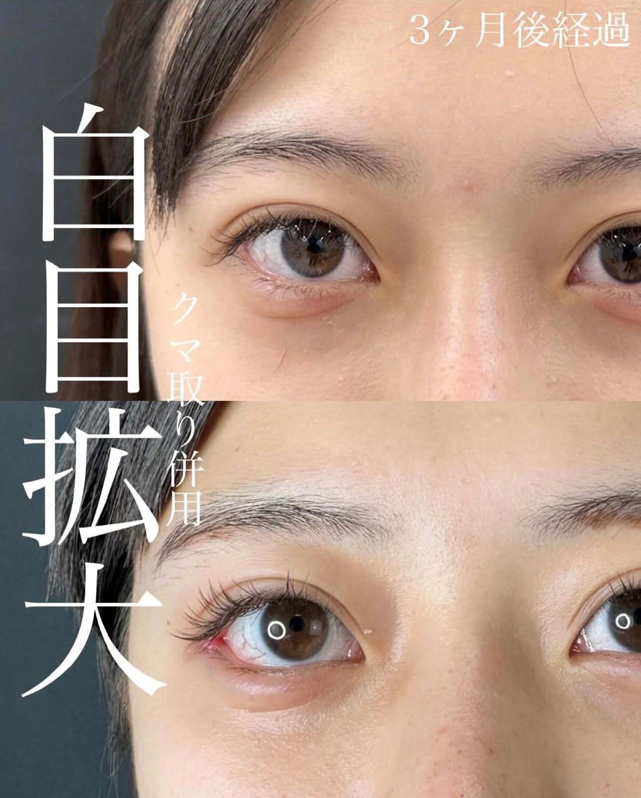 目尻切開法の症例写真