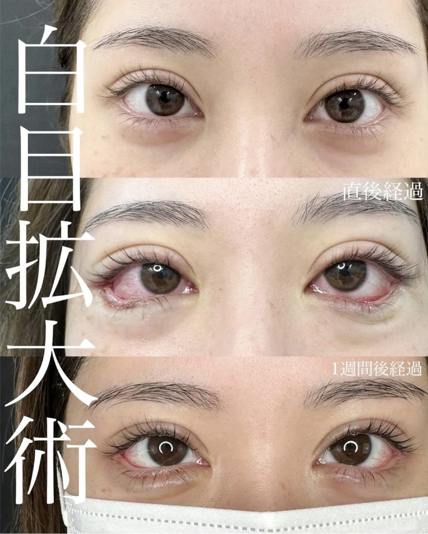 目尻切開法の症例写真