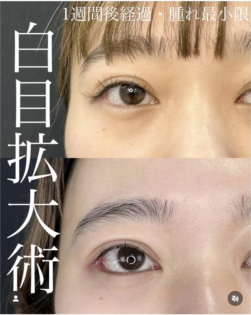 目尻切開法の症例写真