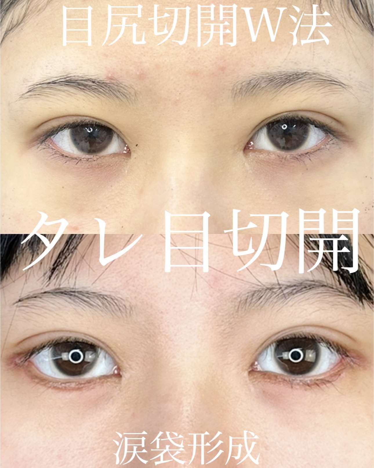 目尻切開法の症例写真