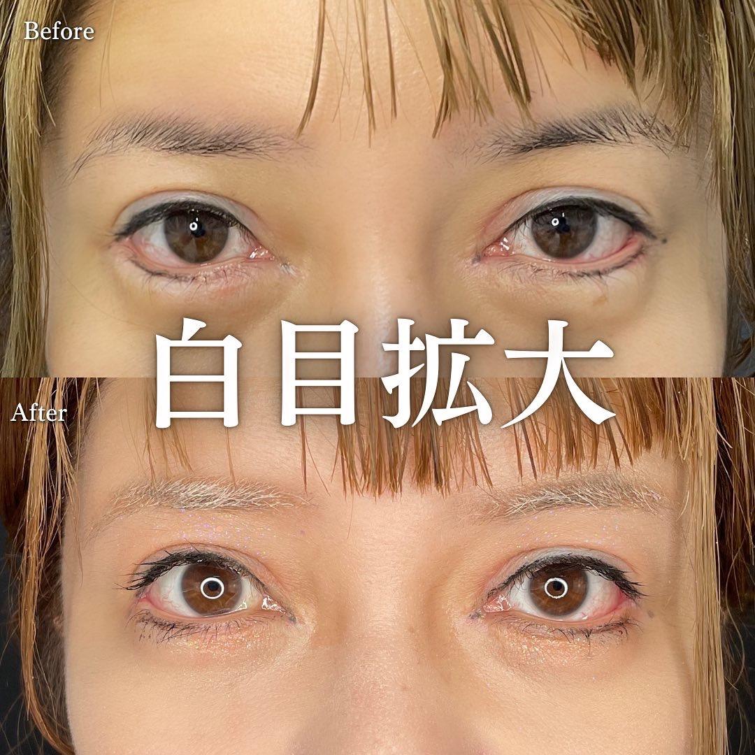 目尻切開法の症例写真