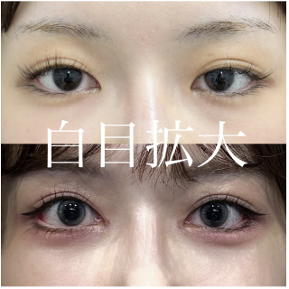 目尻切開法の症例写真