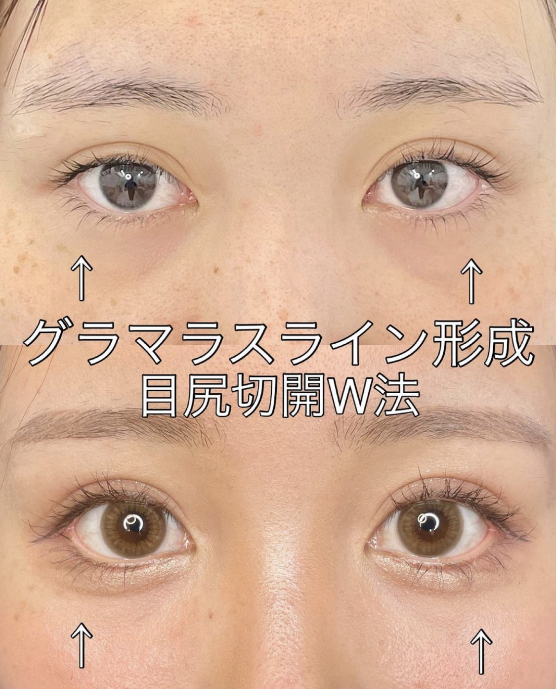 グラマラスライン形成術