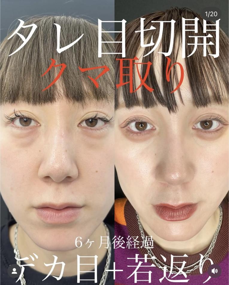 グラマラスライン形成術