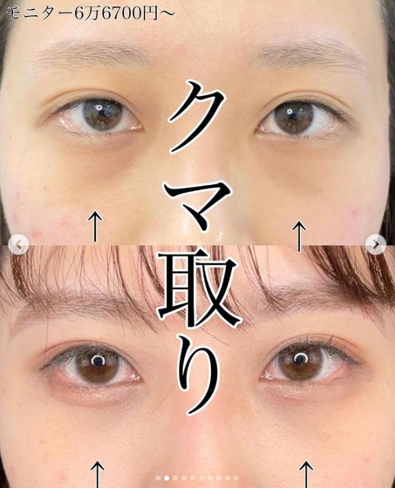 目の下のクマとり