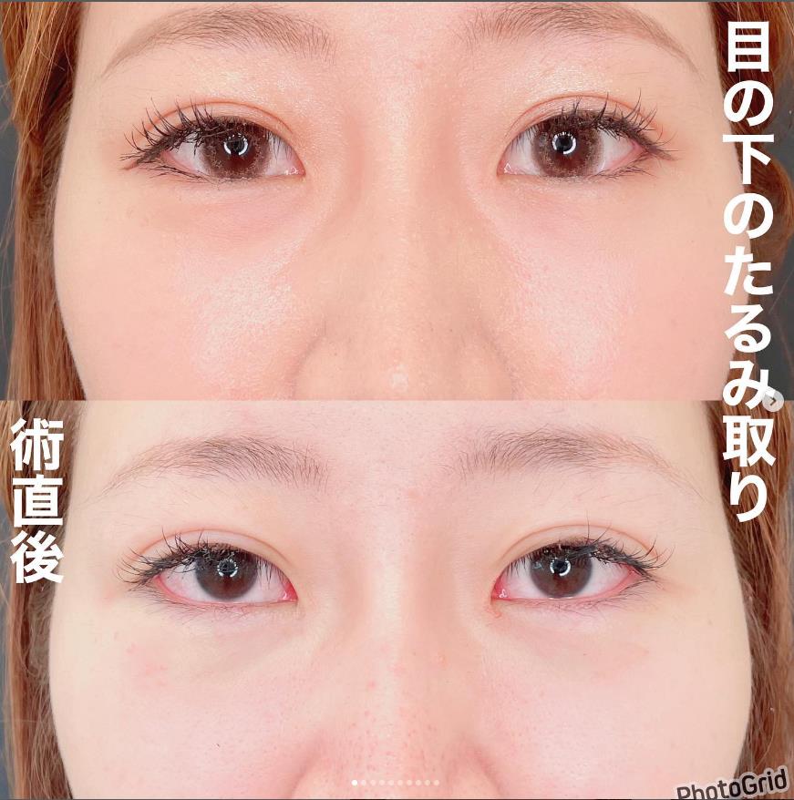 目の下のふくらみ取り
