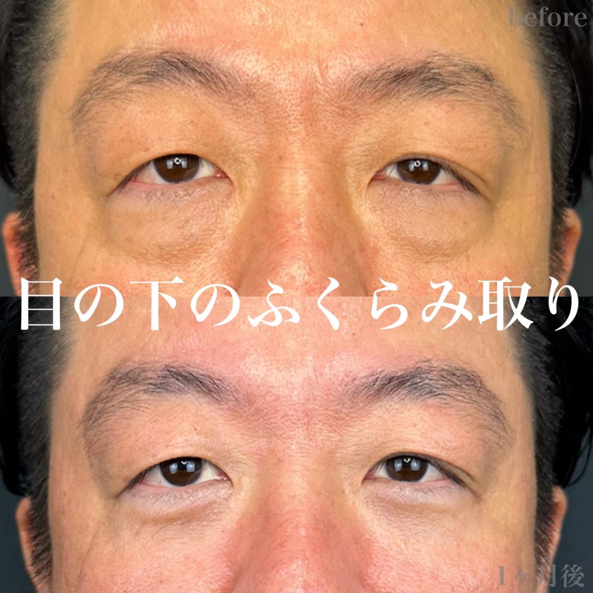 目の下のふくらみ取り
