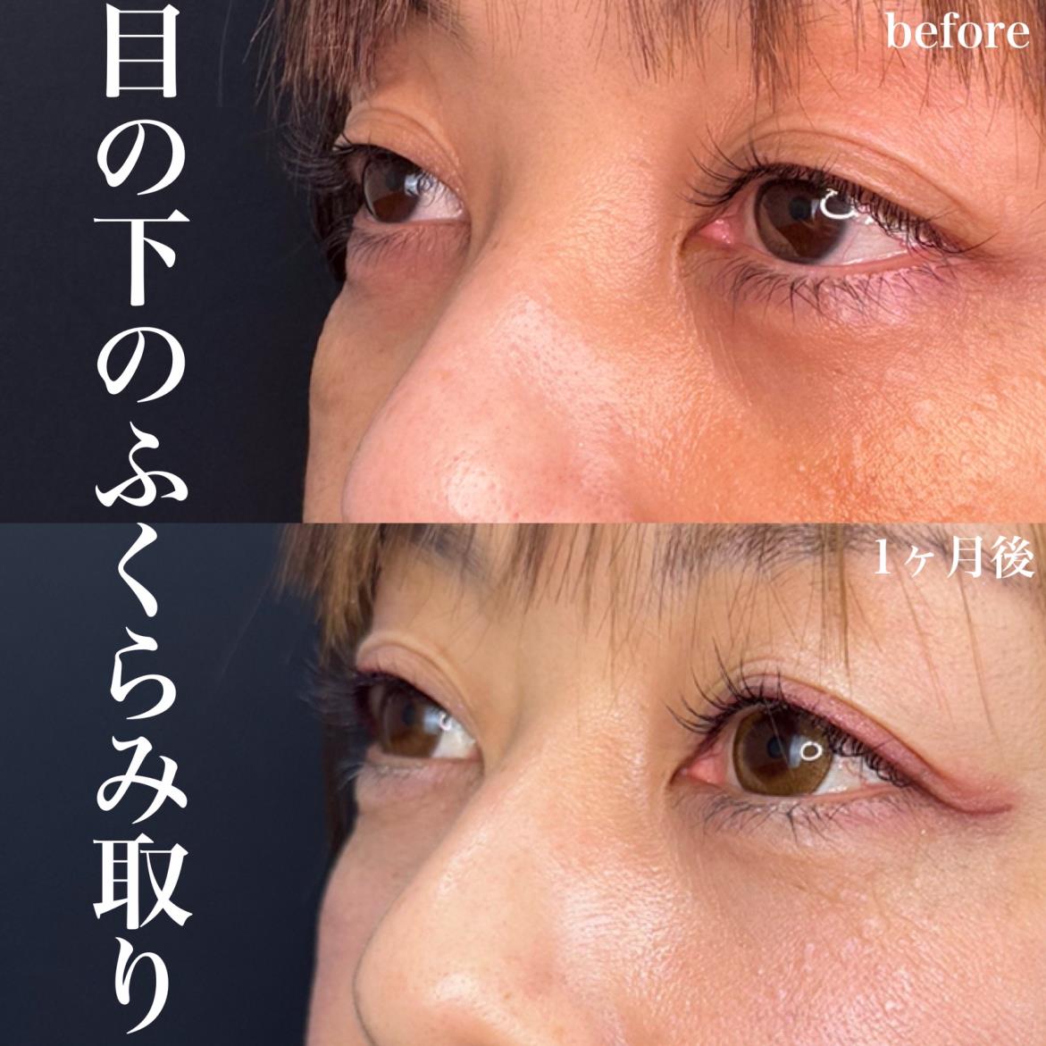 目の下のふくらみ取り