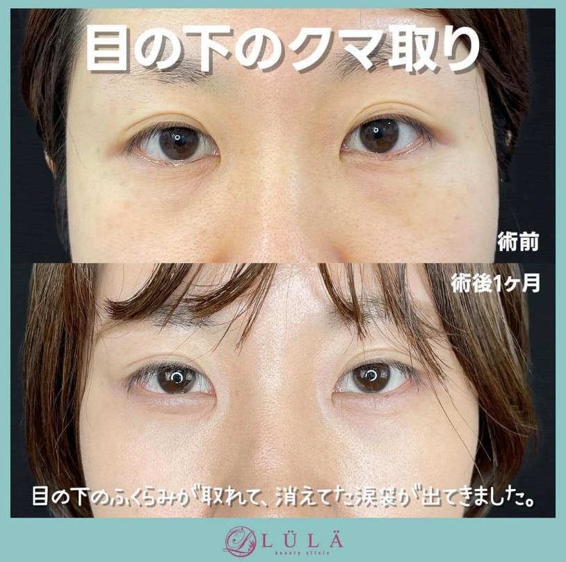 目の下のふくらみ取り