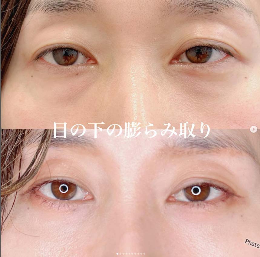 目の下のふくらみ取り