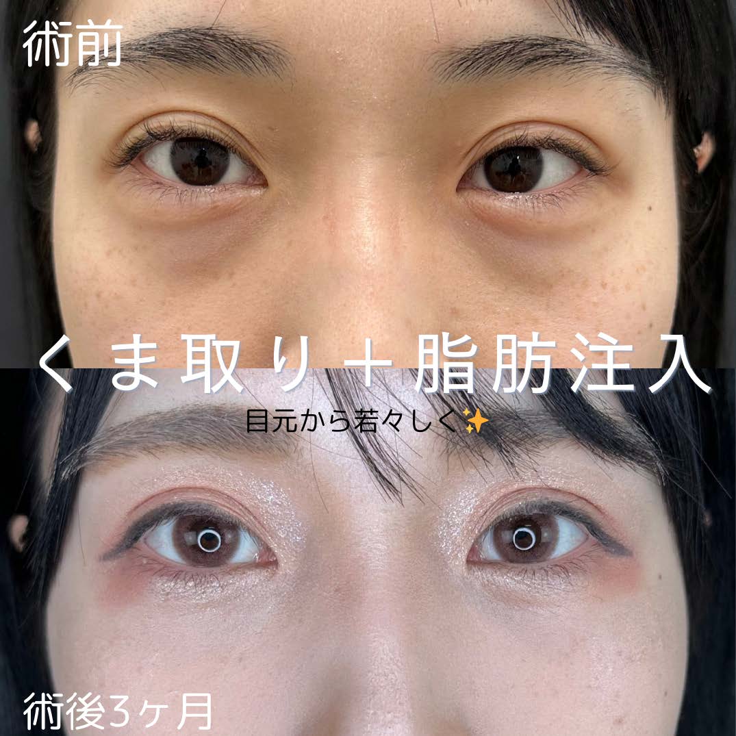 目の下のふくらみ取り
