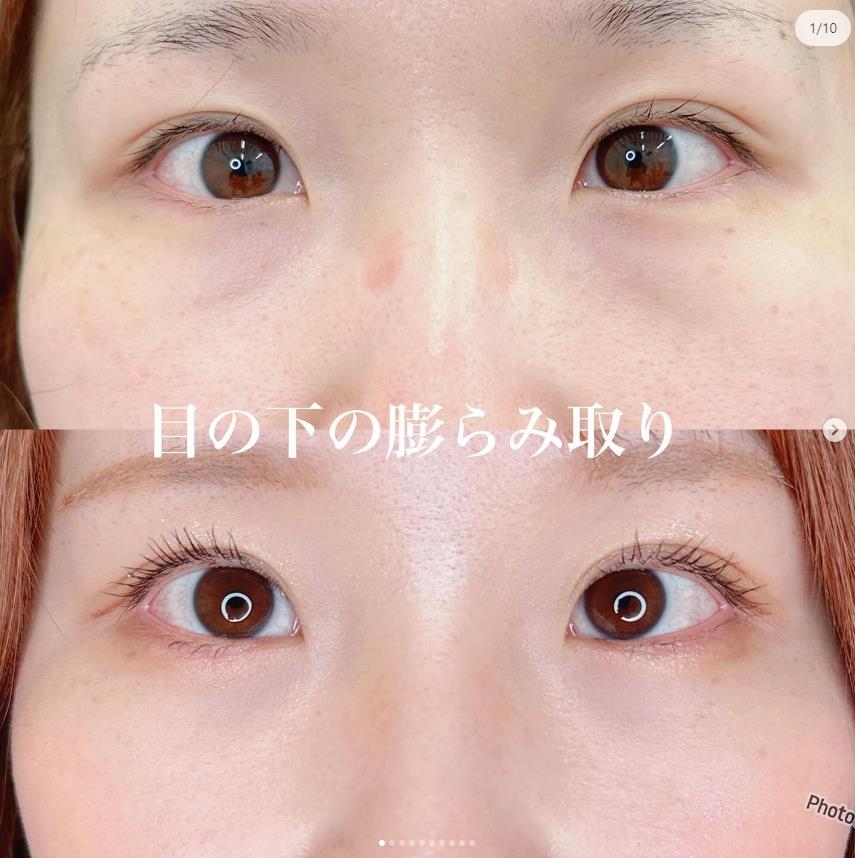 目の下のふくらみ取り