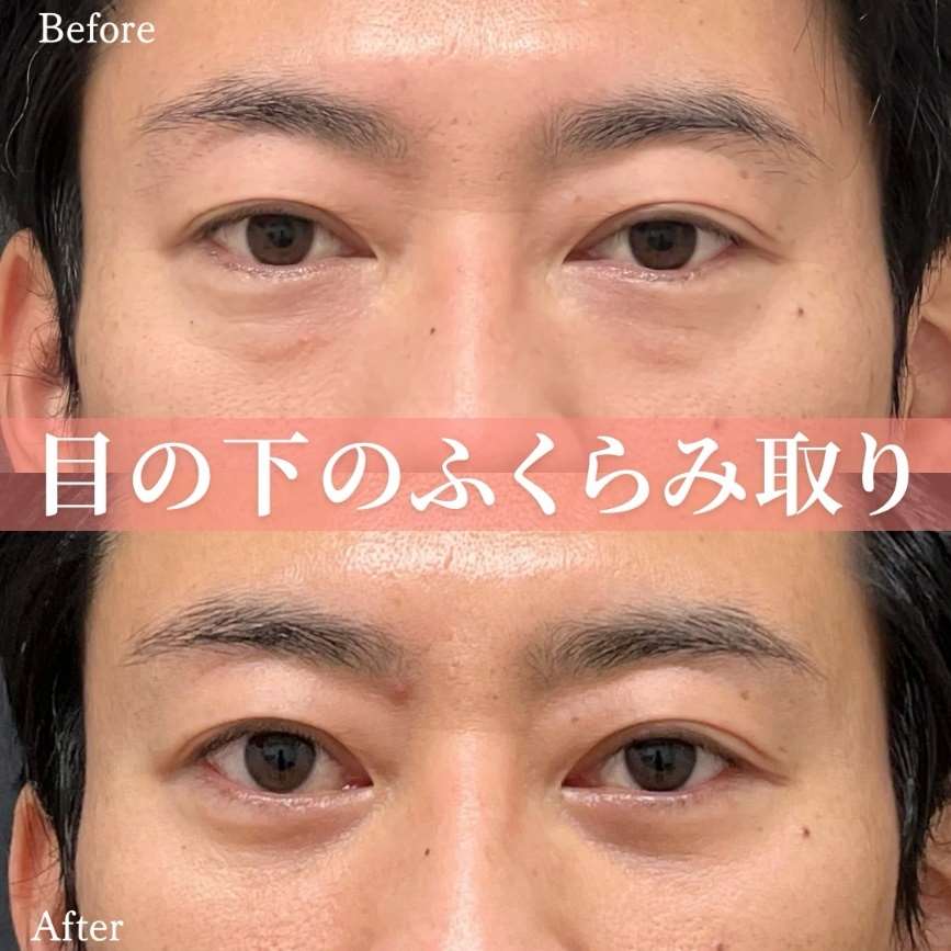 目の下のふくらみ取り