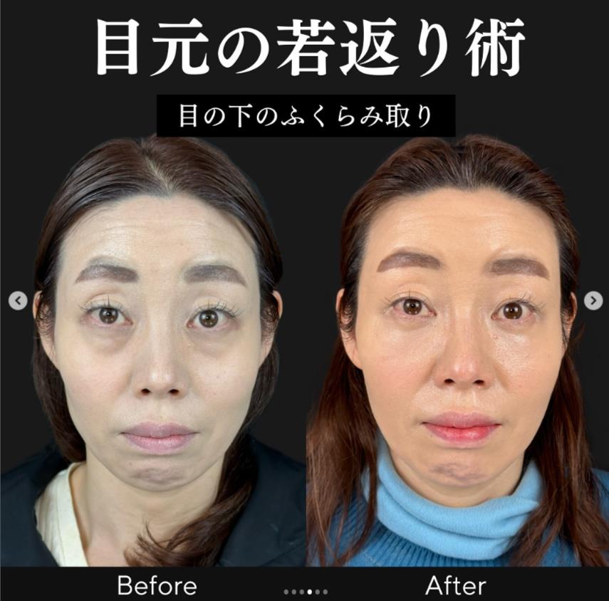 目の下のふくらみ取り
