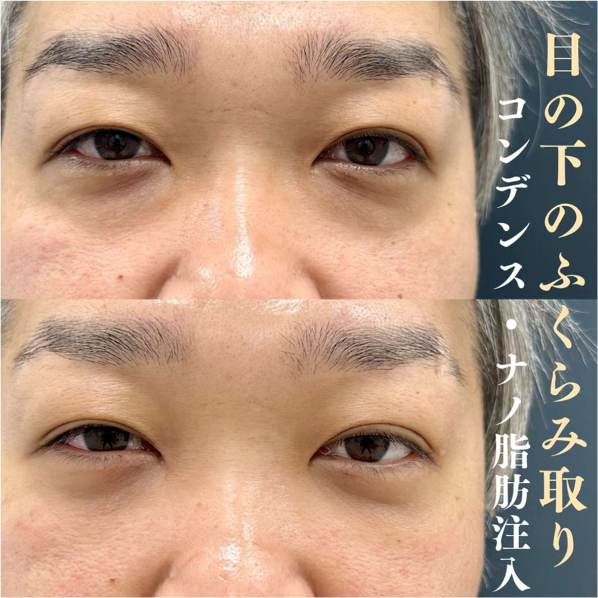 目の下のふくらみ取り