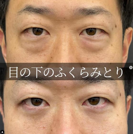 目の下のふくらみ取り