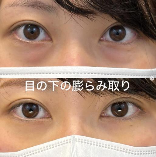 目の下のふくらみ取り