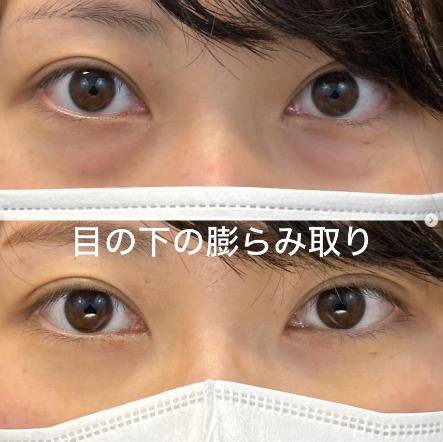目の下のふくらみ取り