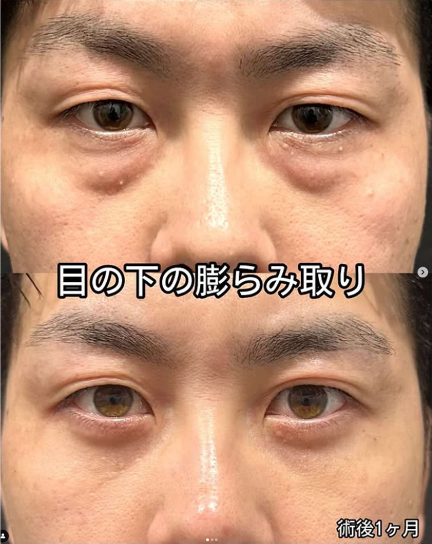 目の下のふくらみ取り